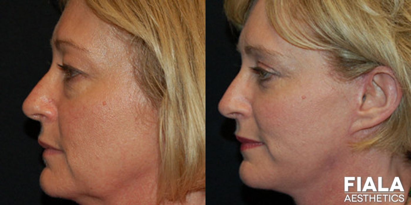 Non-surgical Facial Rejuvenation - Thumbnail 2