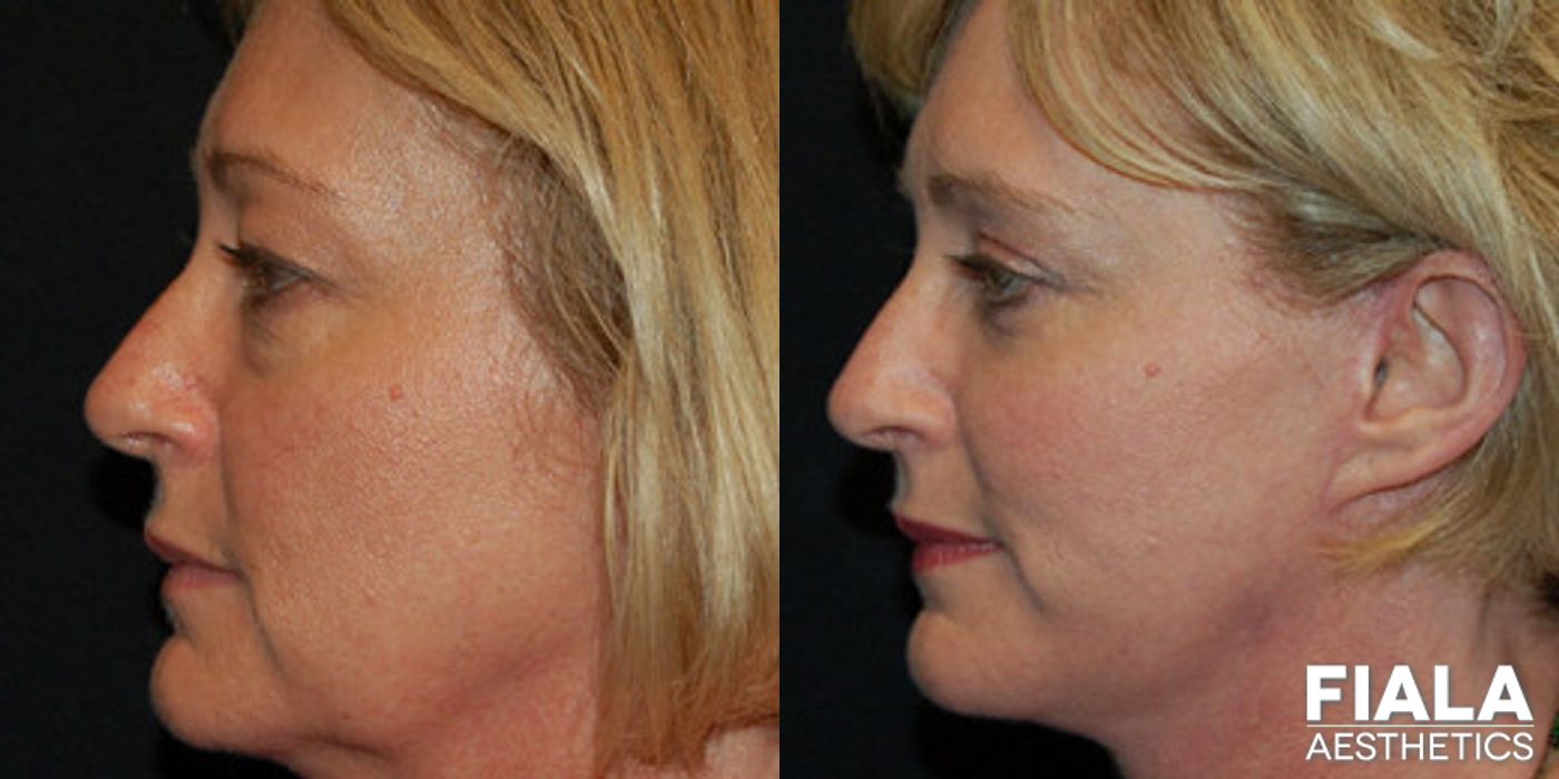 Before and after Facelift case 13885 - Angle 2