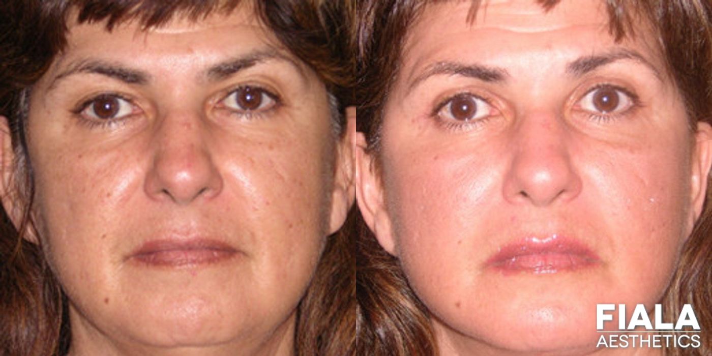 Before and after Dermal Fillers case 13897