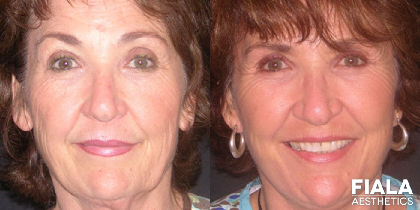 Before and after Neck Lift case 13894