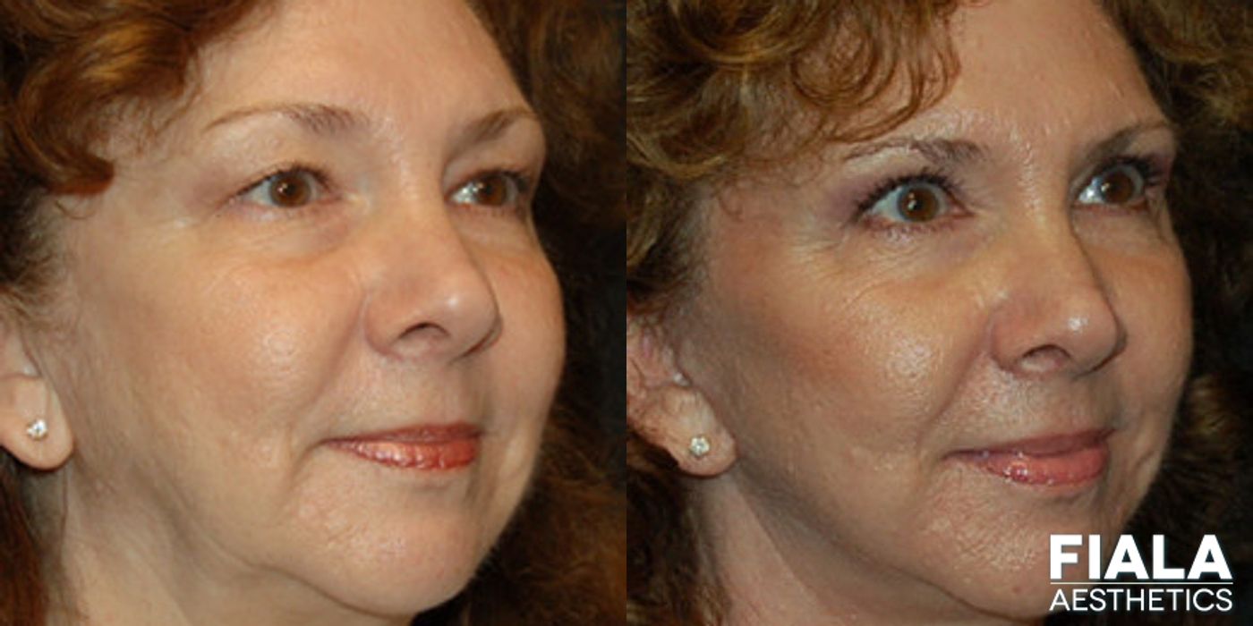 Before and after Facelift case 13888 - Angle 2