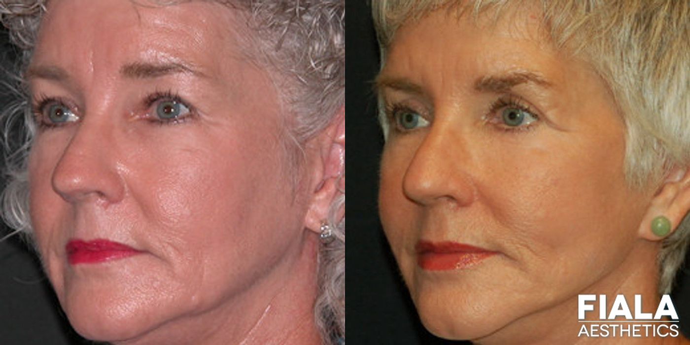 Before and after Neck Lift case 13890 - Angle 2