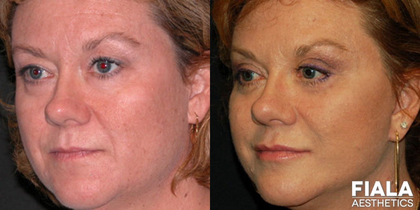 Non-surgical Facial Rejuvenation - Thumbnail 2