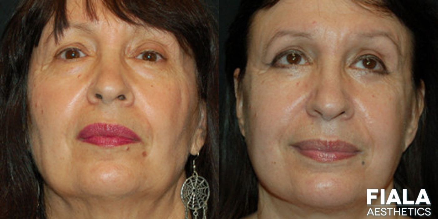 Eyelid Lift - Thumbnail 2