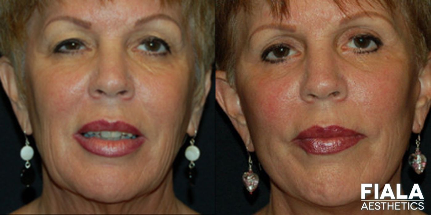 Before and after Facelift case 13891