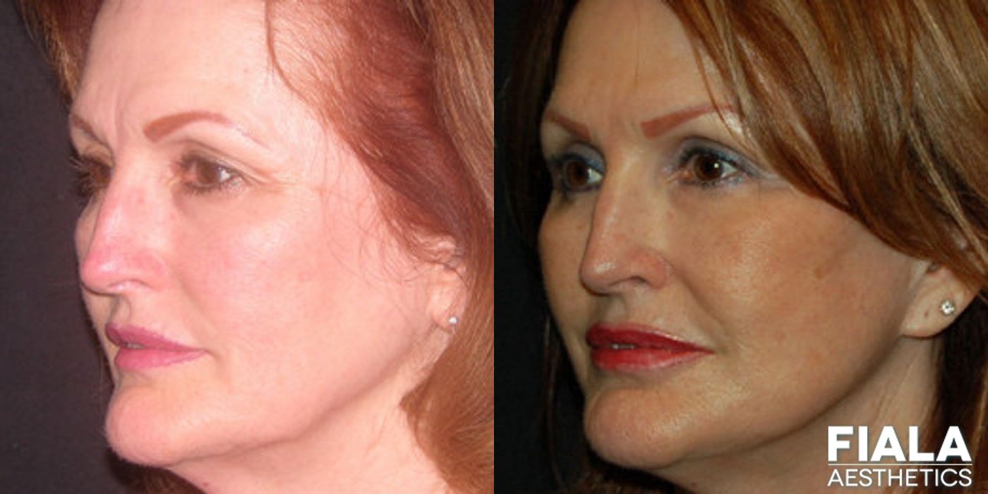 BOTOX Cosmetic - Thumbnail 2