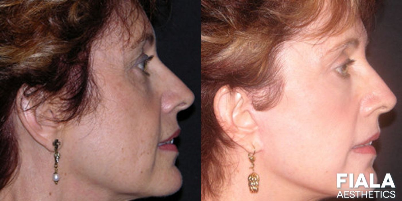 Non-surgical Facial Rejuvenation - Thumbnail 2