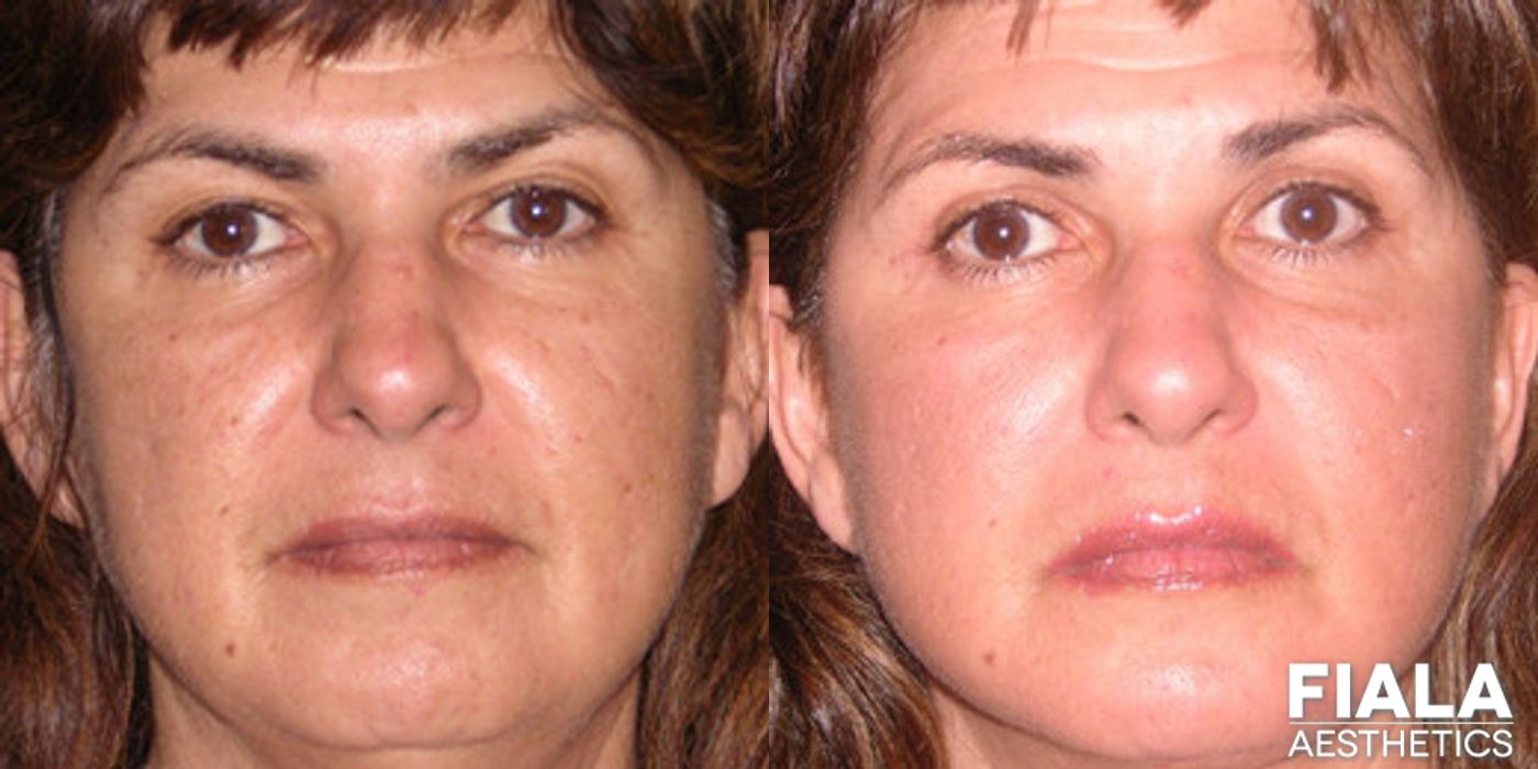 Non-surgical Facial Rejuvenation - Thumbnail 2