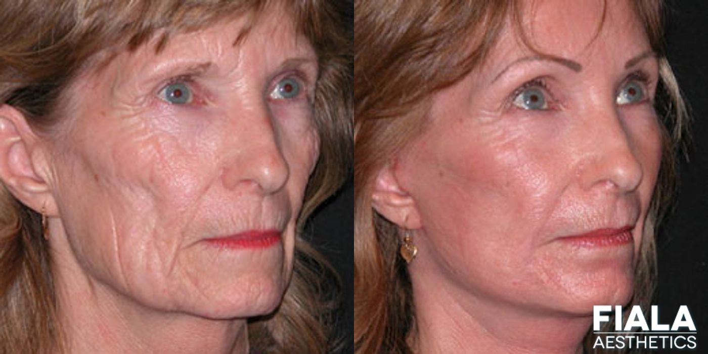 Non-surgical Facial Rejuvenation - Thumbnail 2