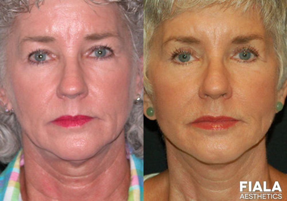 BOTOX Cosmetic - Case 9016