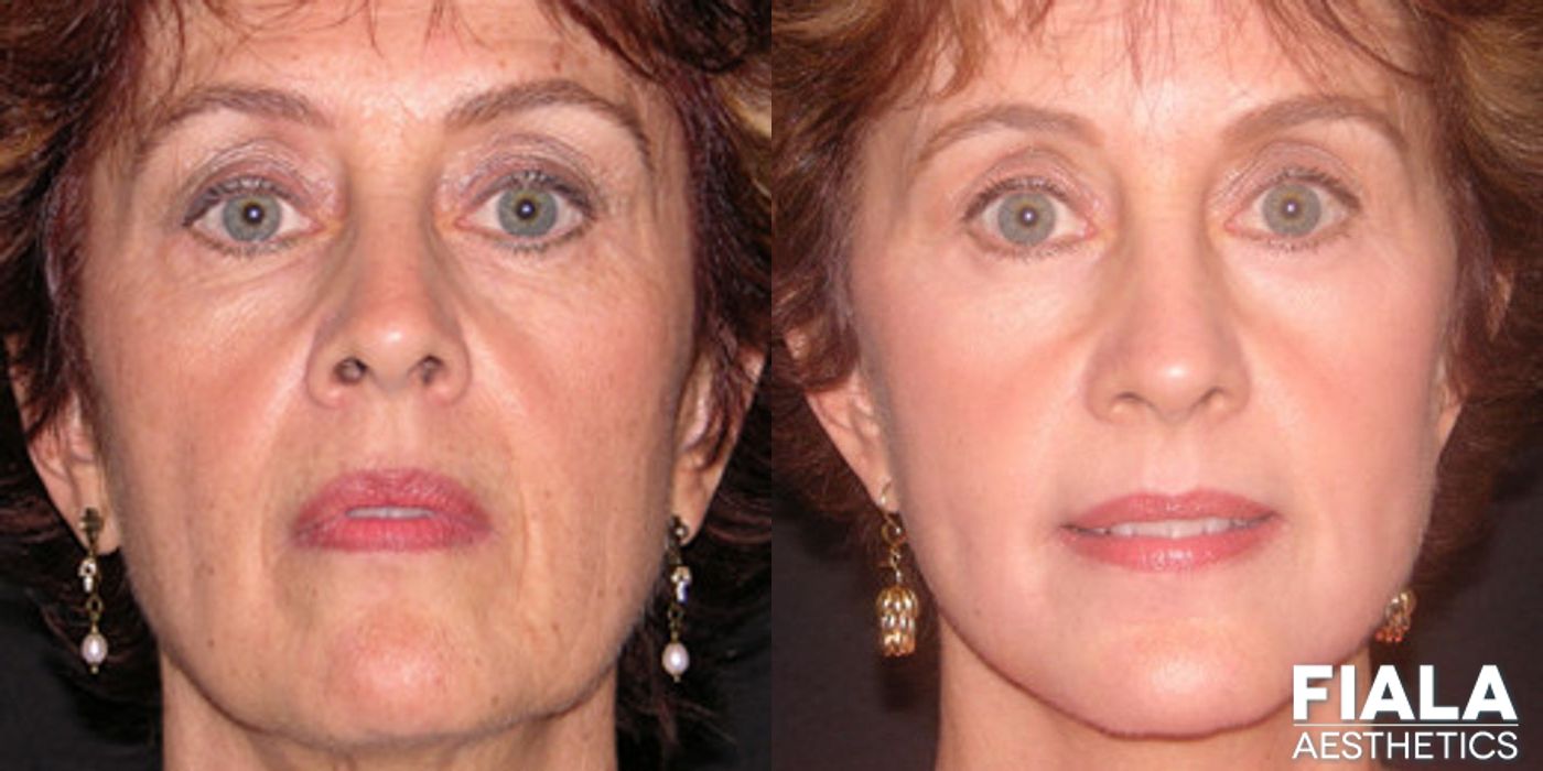 Non-surgical Facial Rejuvenation - Case 9302