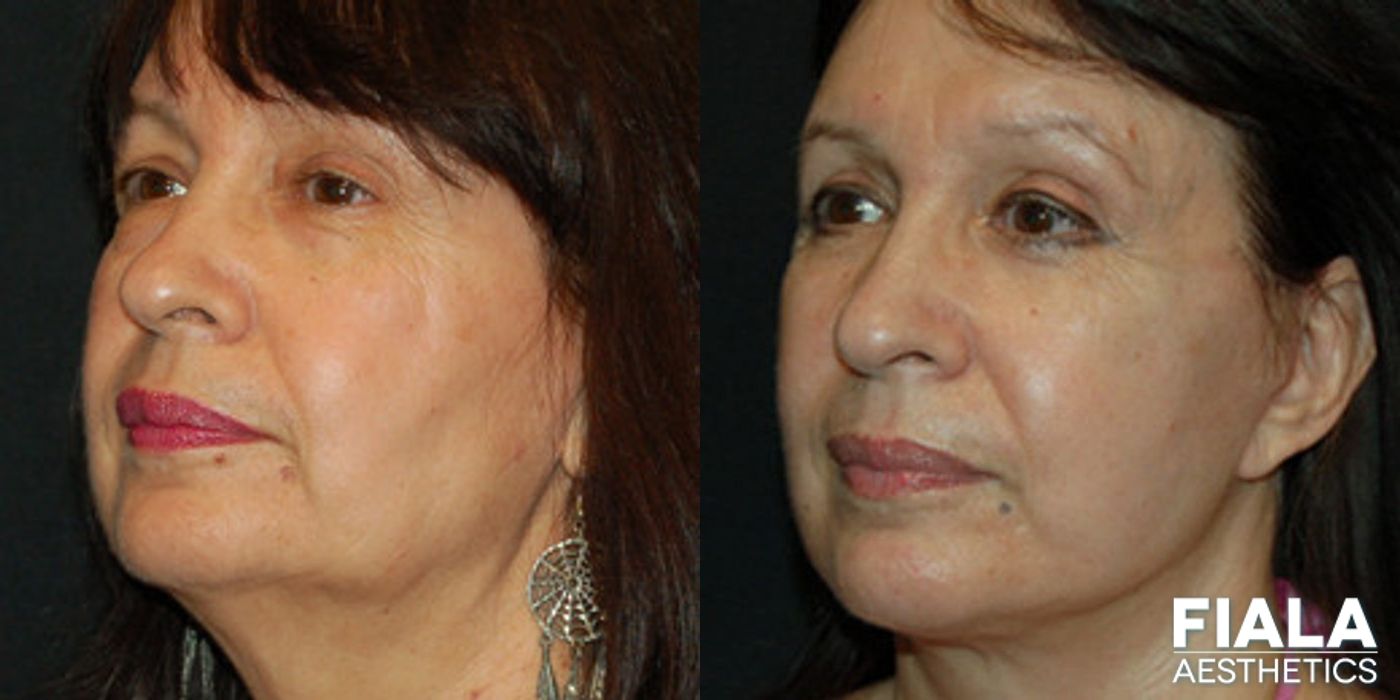 Before and after Eyelid Lift case 13887 - Angle 2