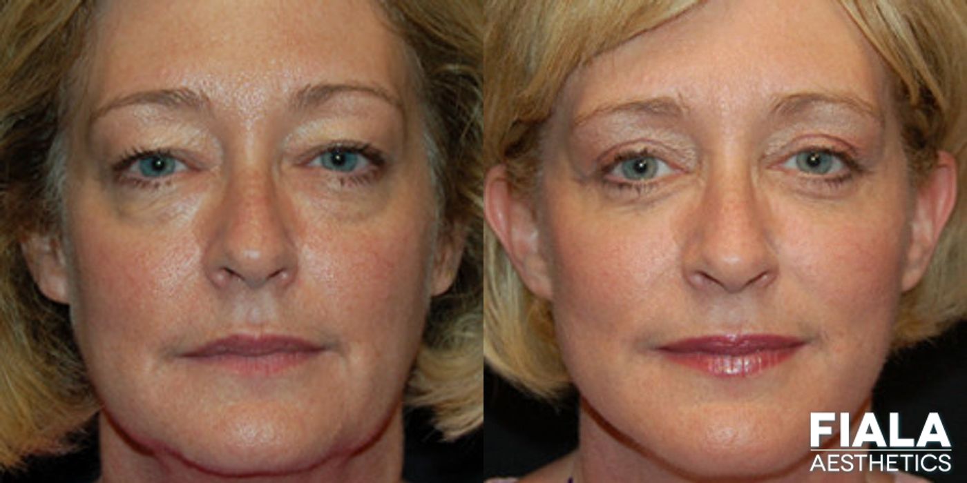 Before and after Facelift case 13885
