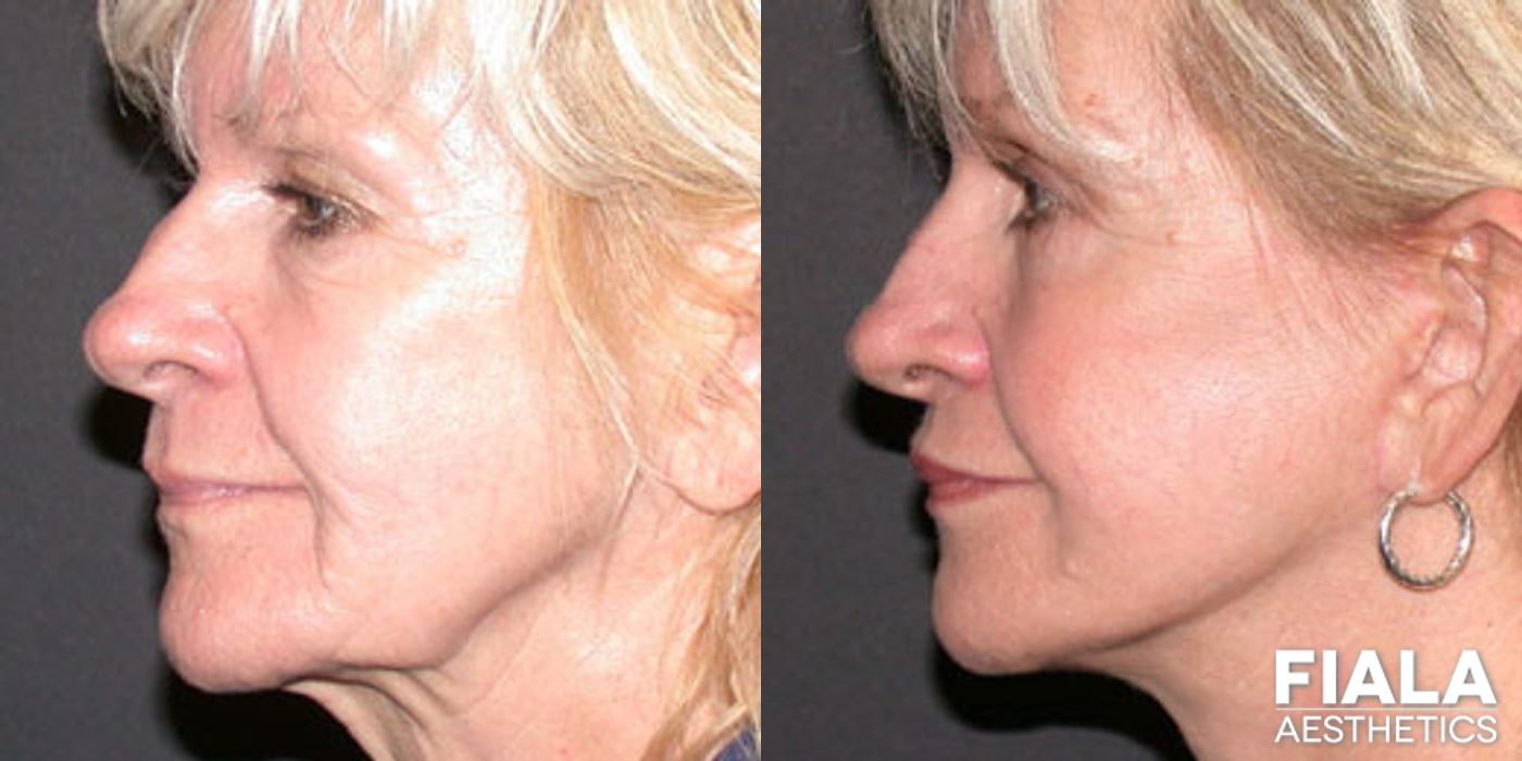 Before and after Dermal Fillers case 13883 - Angle 2