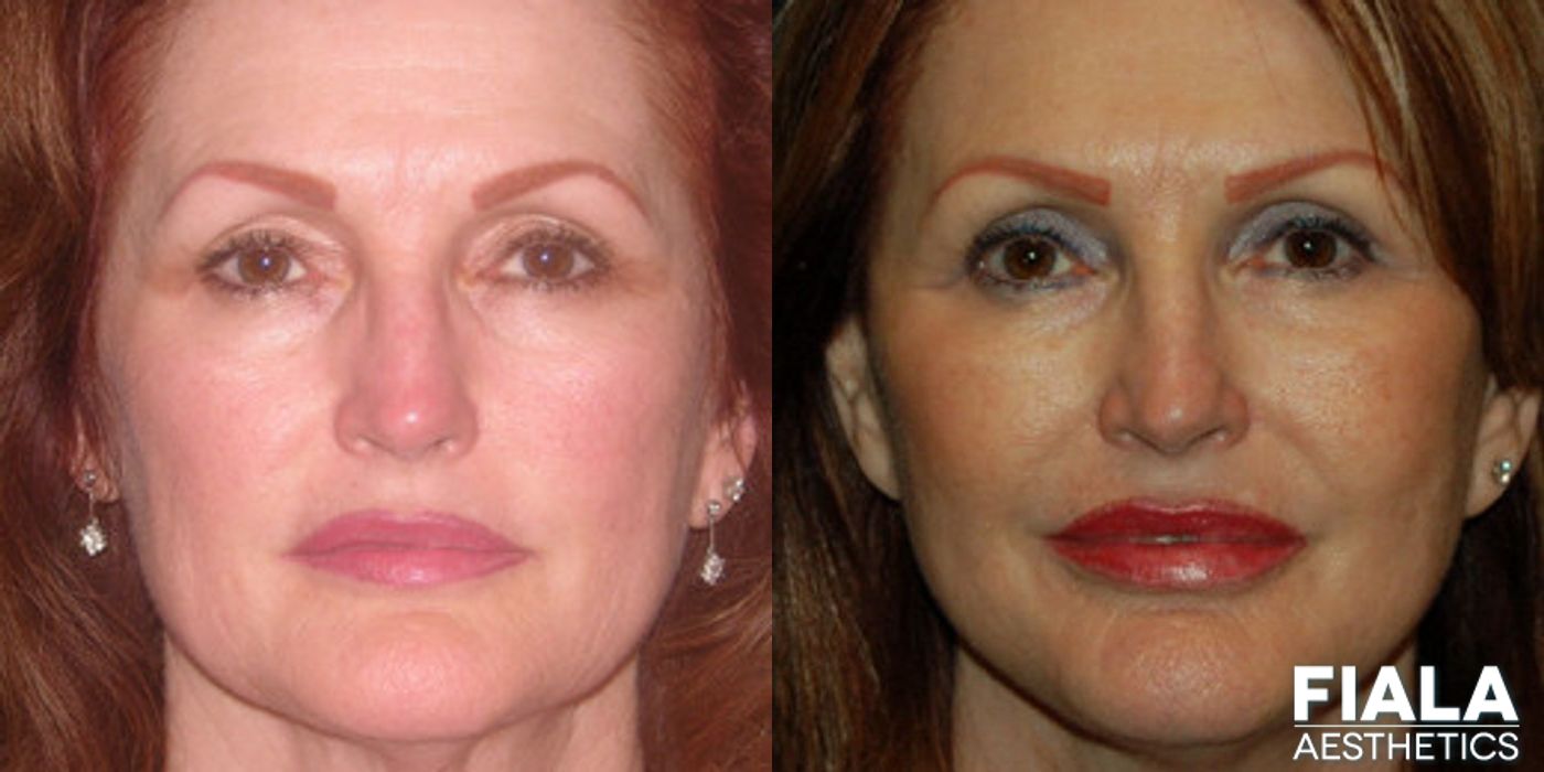 BOTOX Cosmetic - Case 9310