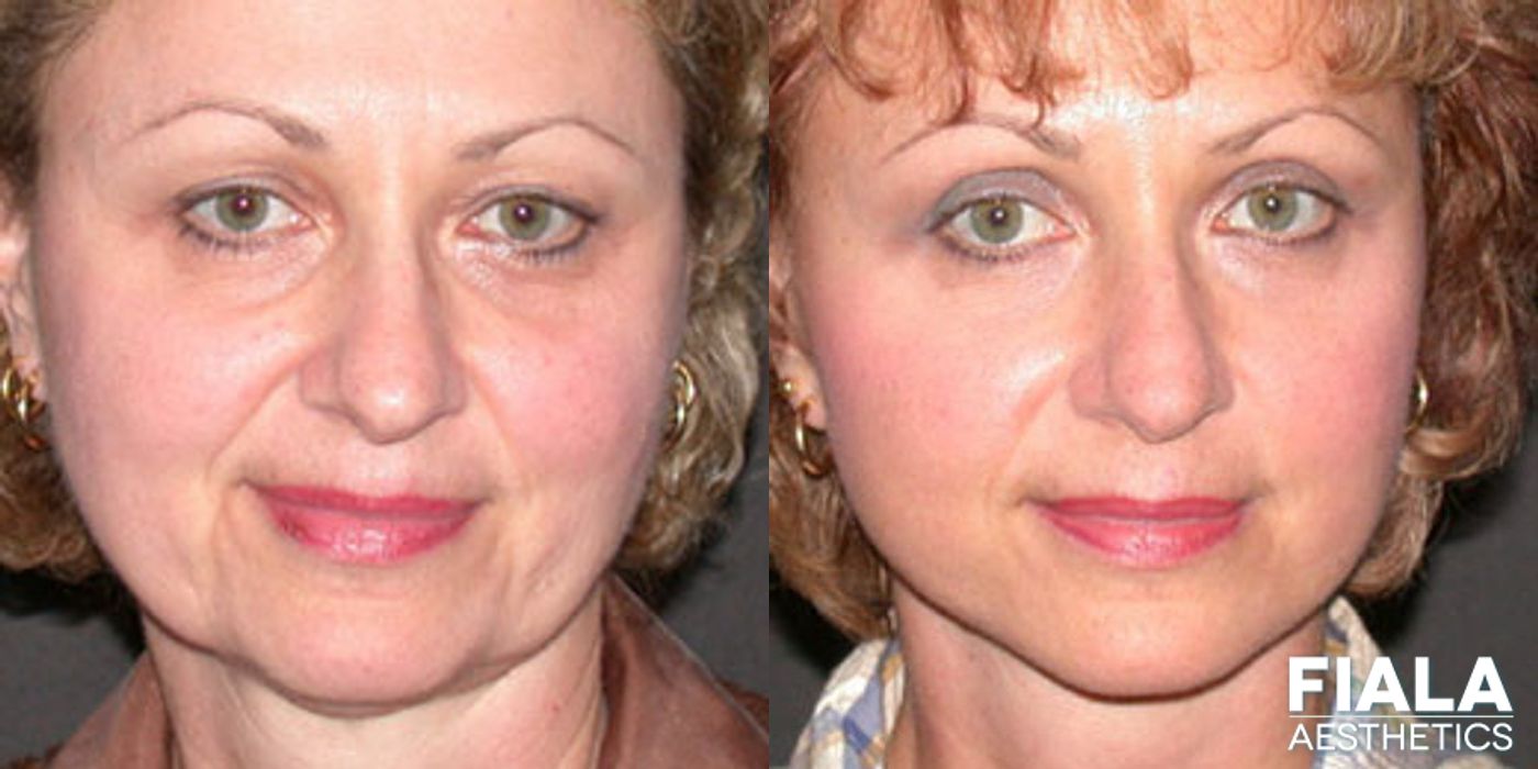 Before and after Facelift case 13884