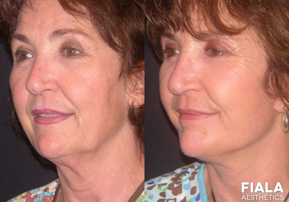 Dermal Fillers - Thumbnail 2