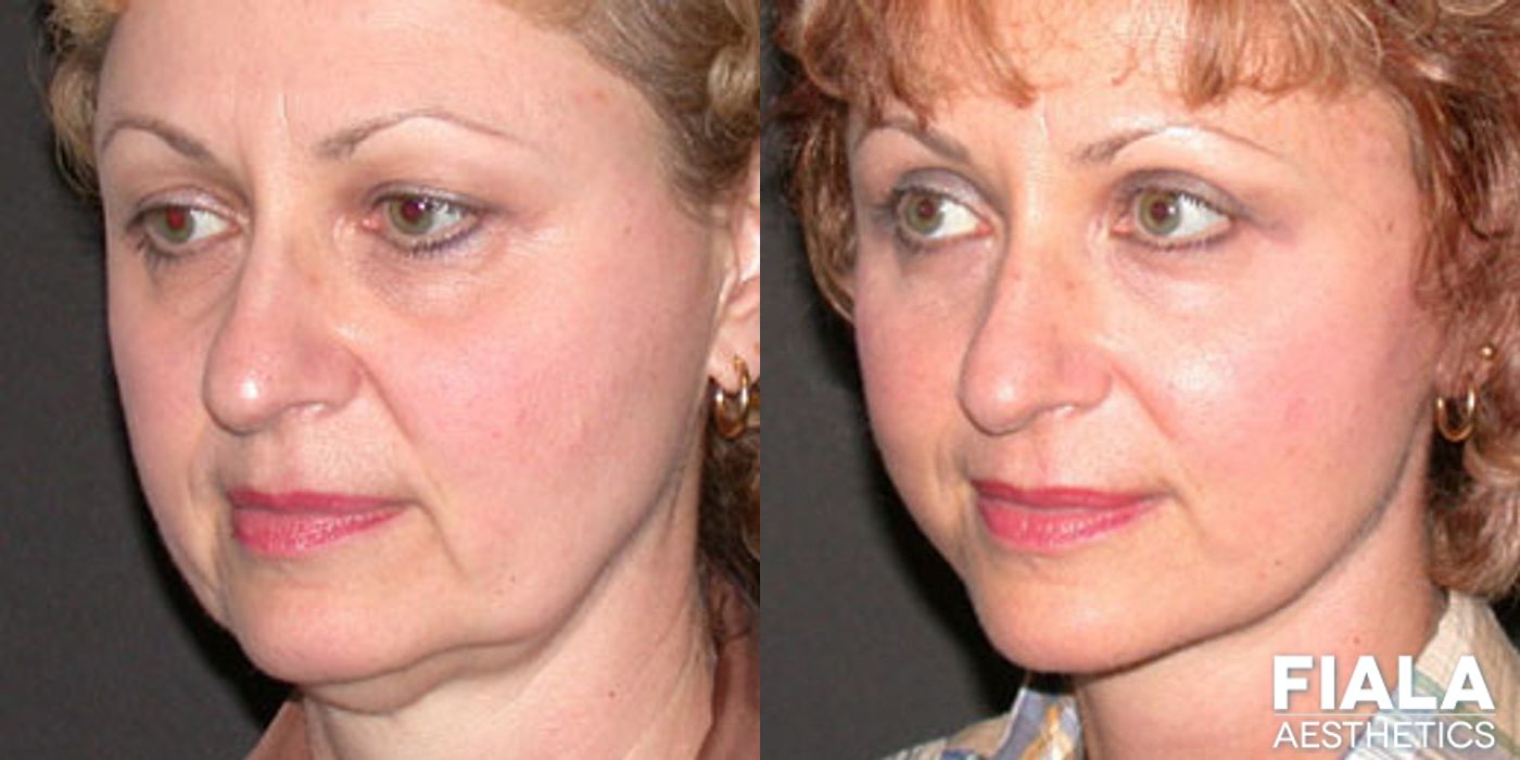 Fillers - Thumbnail 2