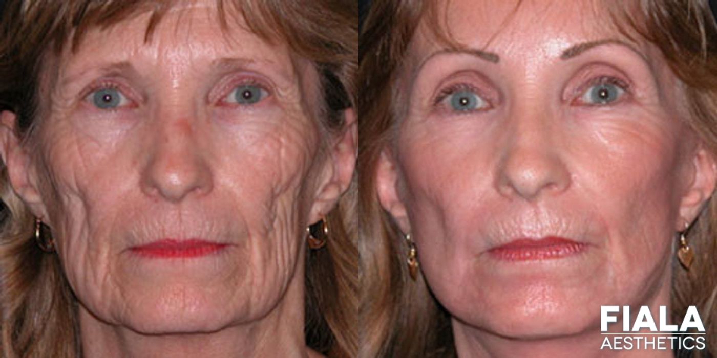 Before and after Dermal Fillers case 13895