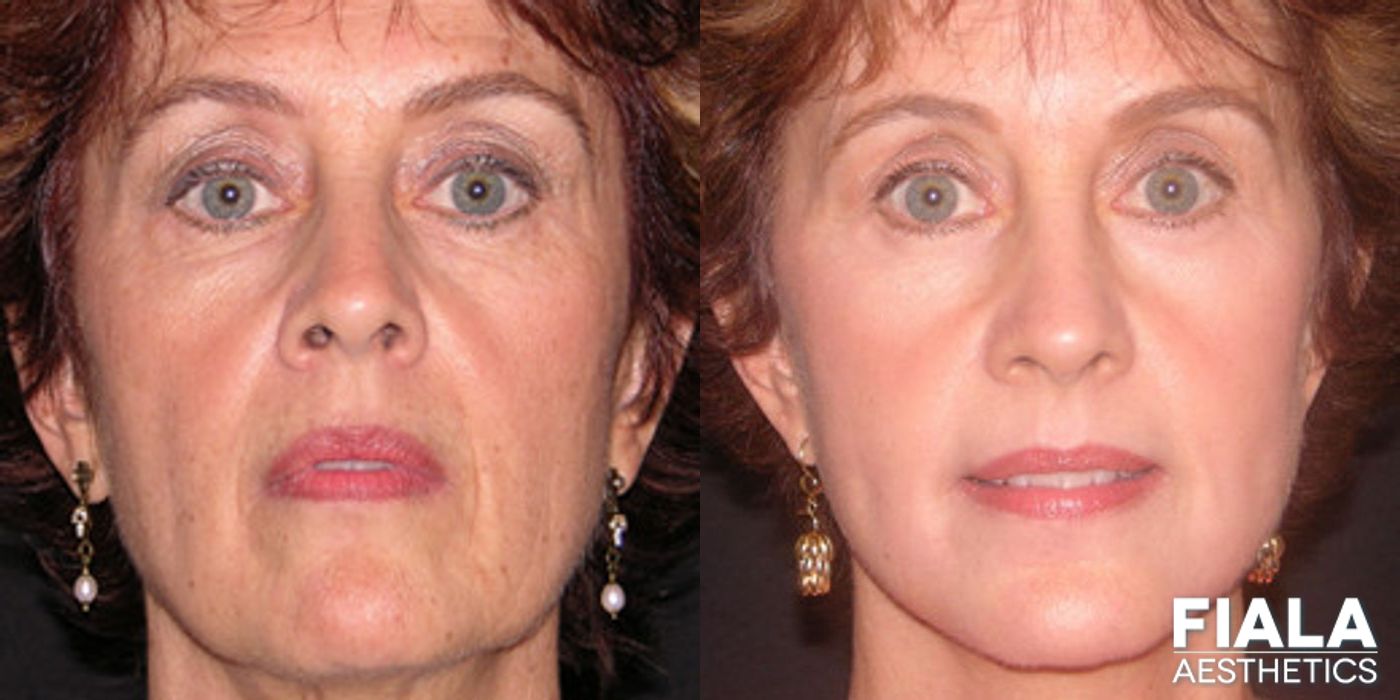 Before and after Facelift case 13896