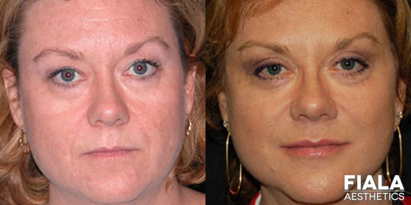 Before and after Facelift case 13886