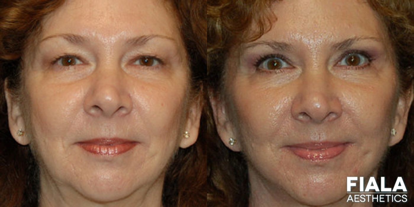 Before and after Facelift case 13888