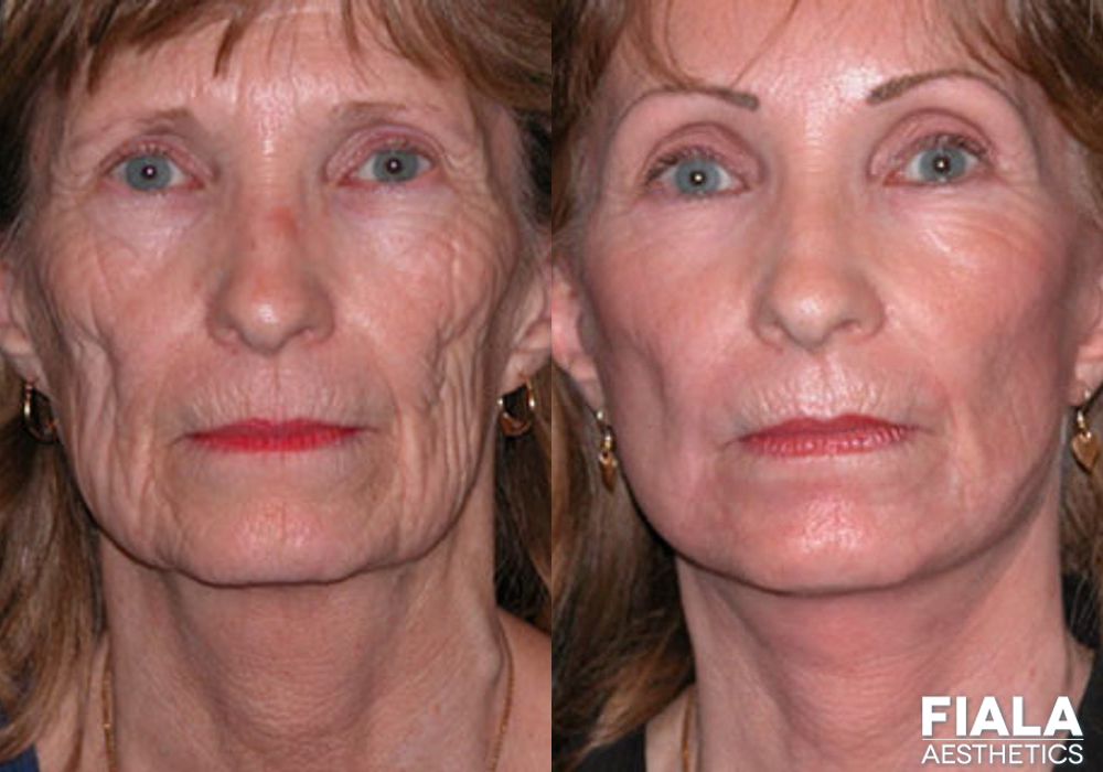 BOTOX Cosmetic - Case 9020