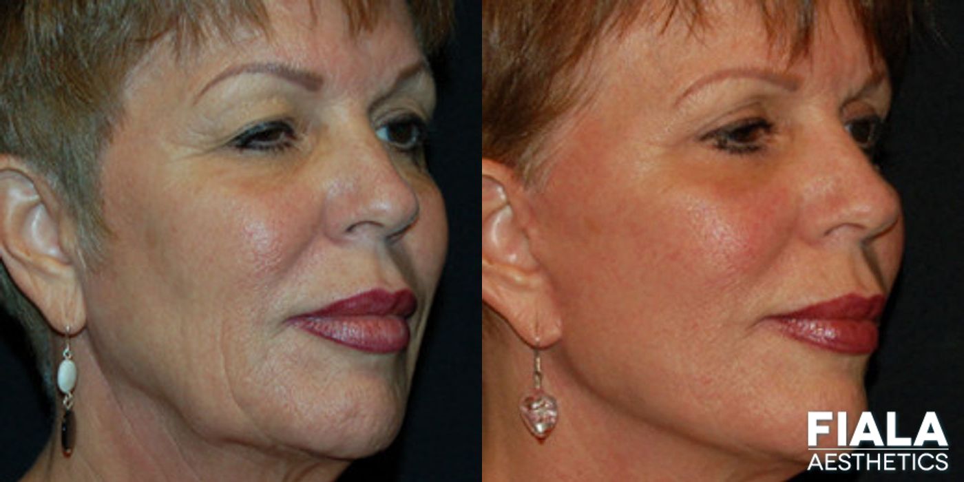 Before and after Facelift case 13891 - Angle 2