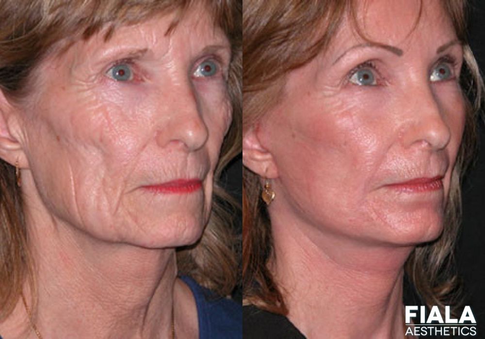 BOTOX Cosmetic - Thumbnail 2