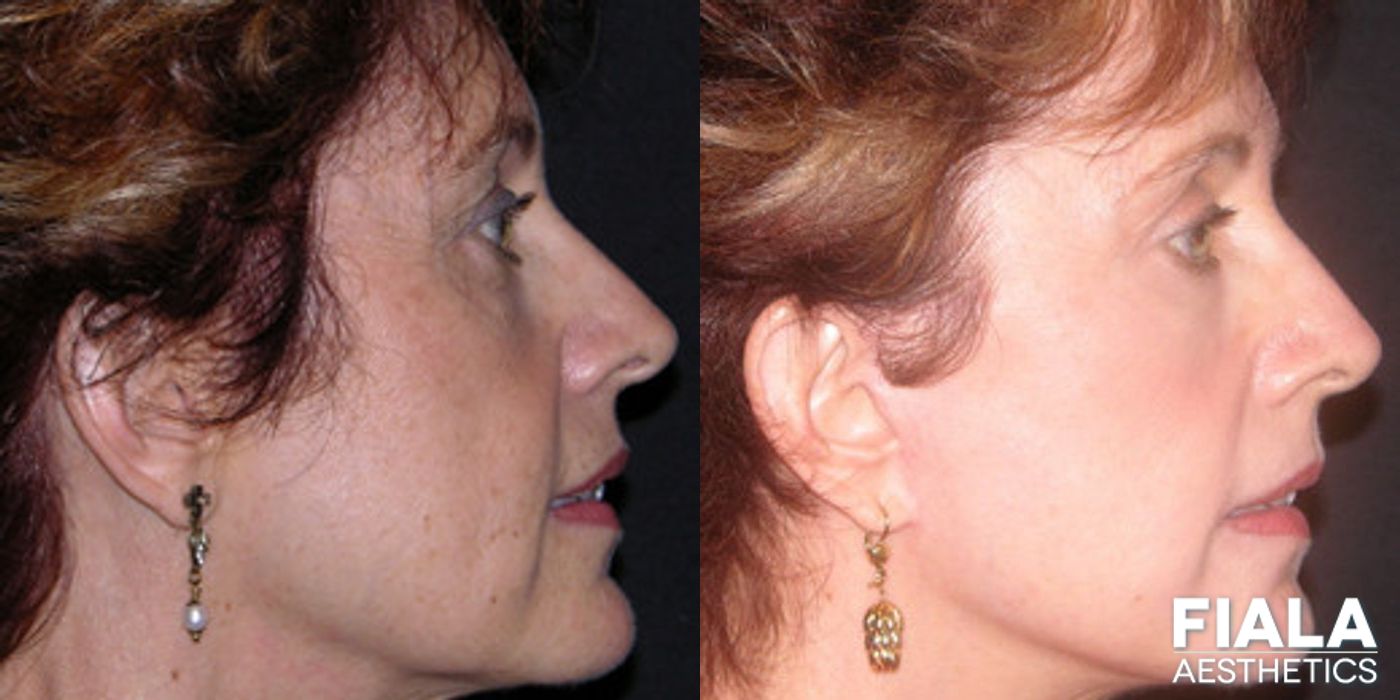 Before and after Facelift case 13896 - Angle 2