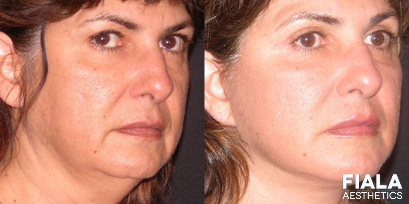 Before and after Dermal Fillers case 13897 - Angle 2