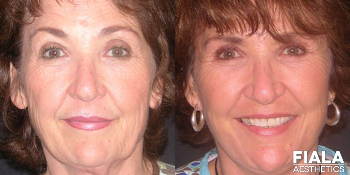 Non-surgical Facial Rejuvenation - Case 9300