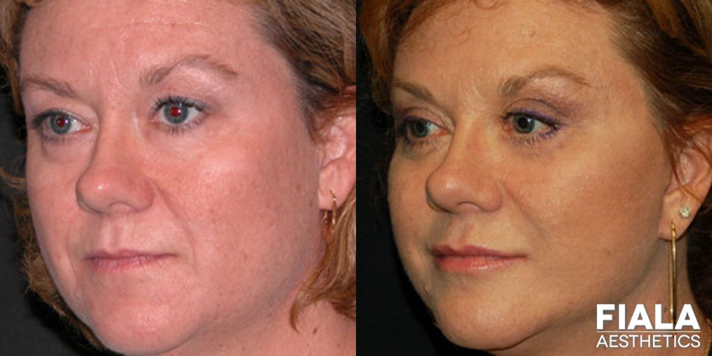 Before and after Facelift case 13886 - Angle 2