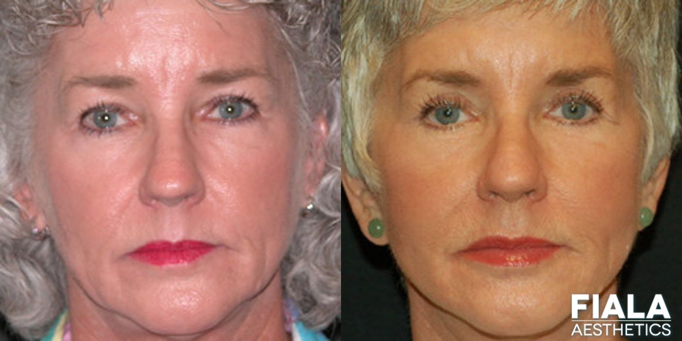 Non-surgical Facial Rejuvenation - Case 9298