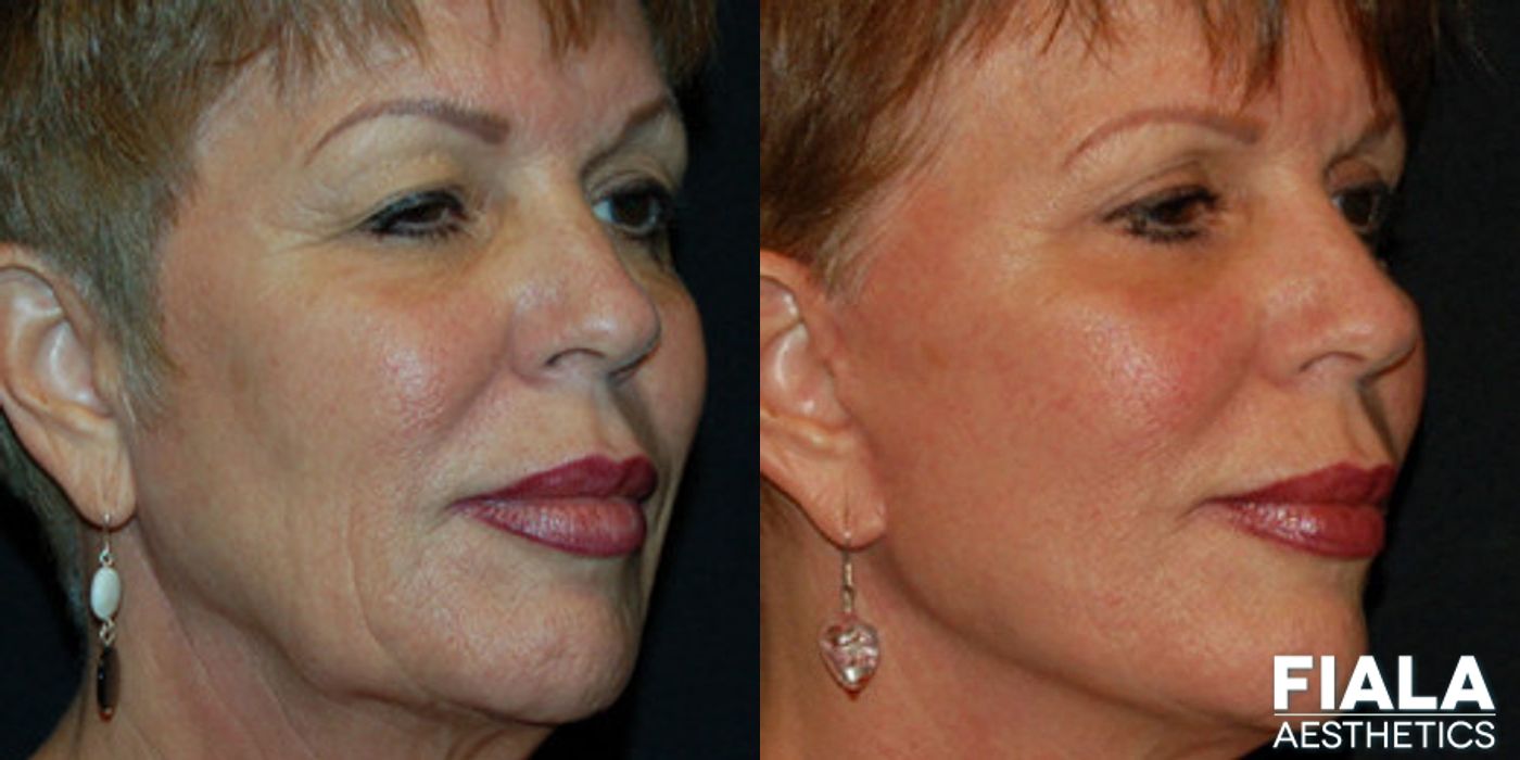 BOTOX Cosmetic - Thumbnail 2