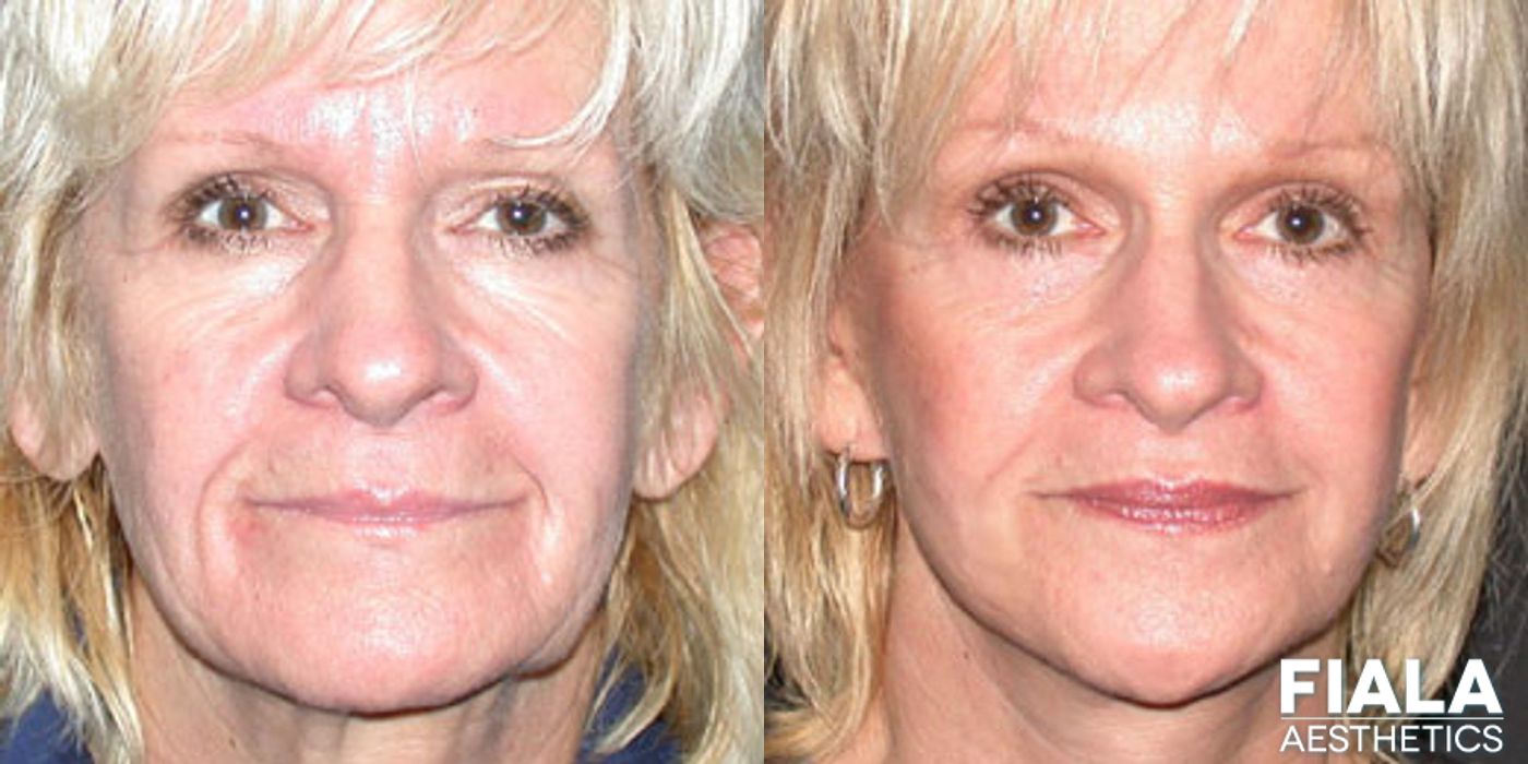 Eyelid Lift - Case 9239