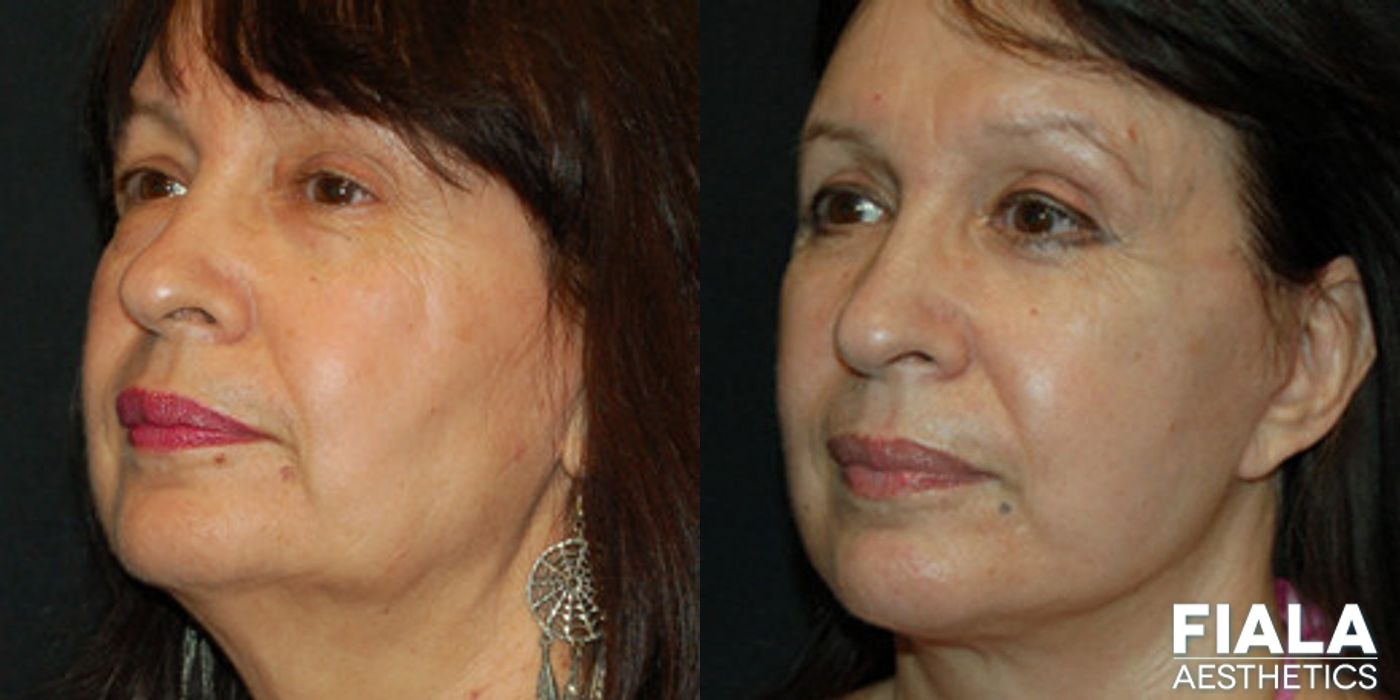 Eyelid Lift - Case 9243