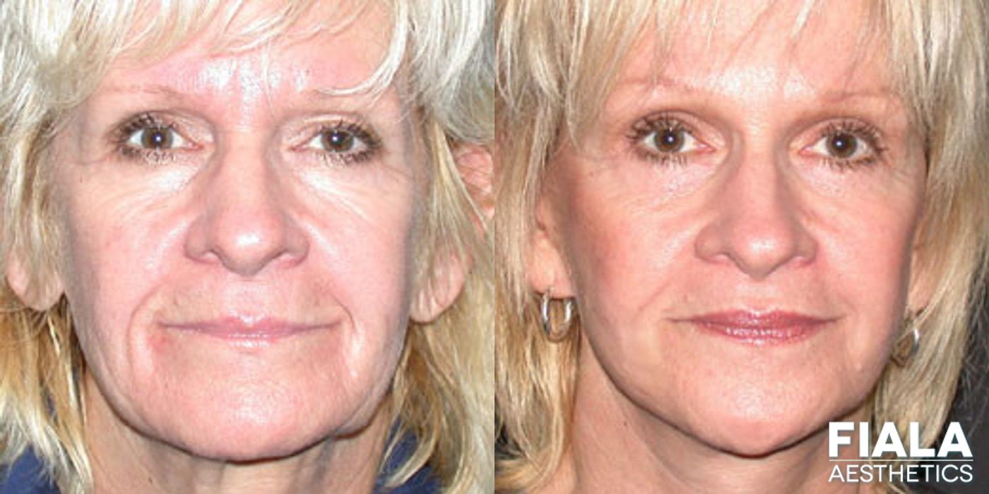 Before and after Dermal Fillers case 13883