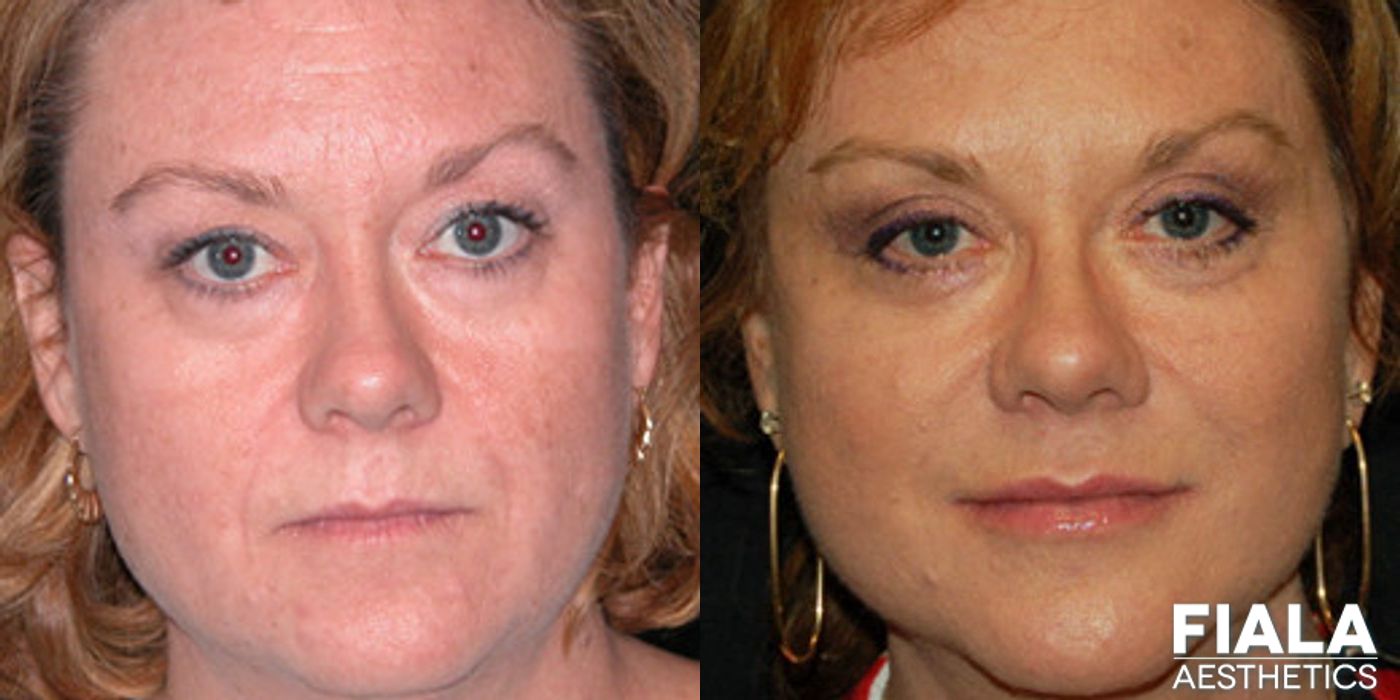 Non-surgical Facial Rejuvenation - Case 9297