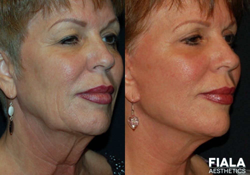 BOTOX Cosmetic - Thumbnail 2