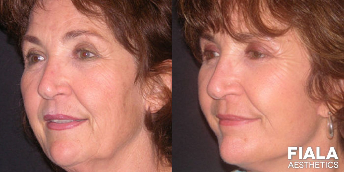 Before and after Neck Lift case 13894 - Angle 2