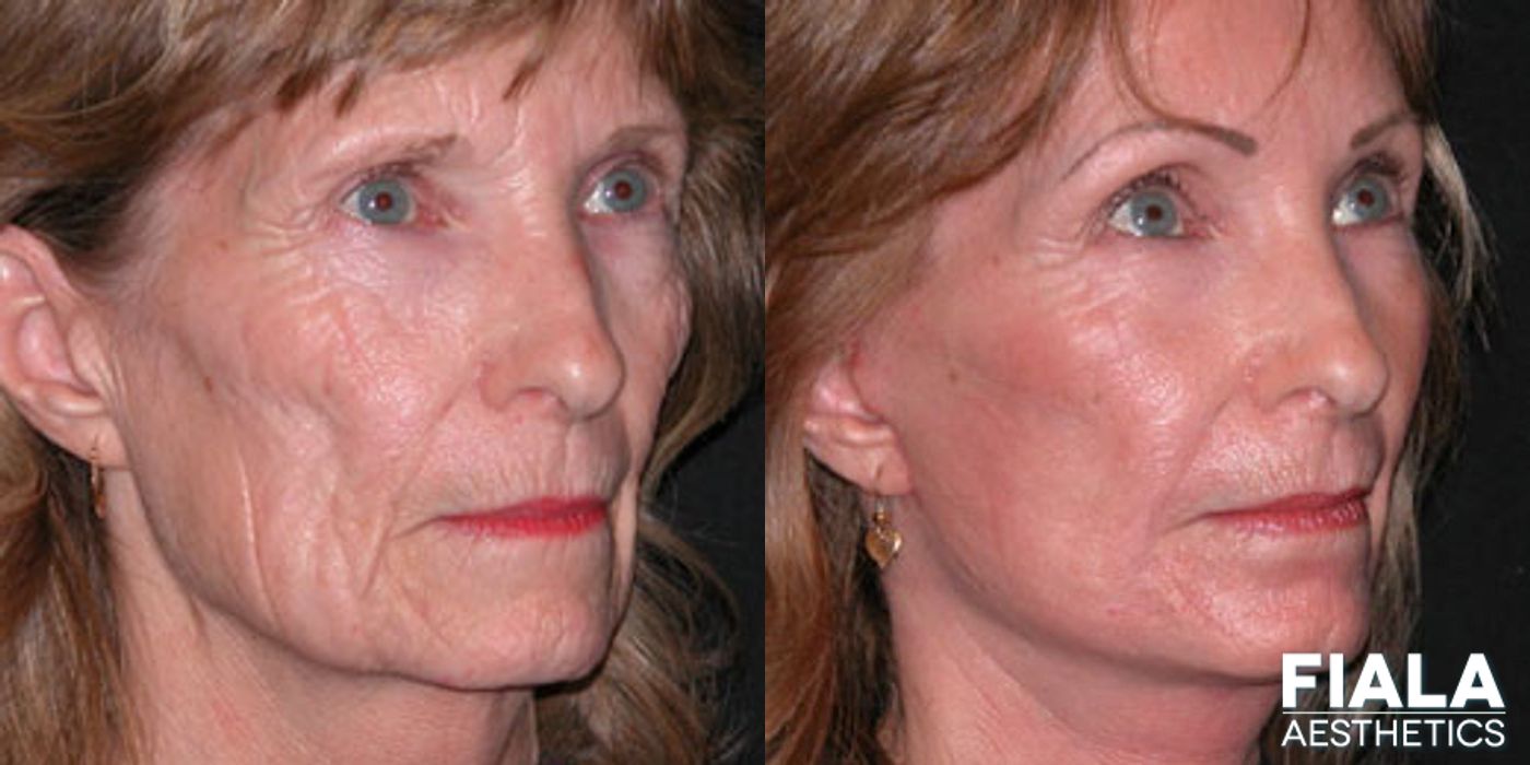 Before and after Dermal Fillers case 13895 - Angle 2