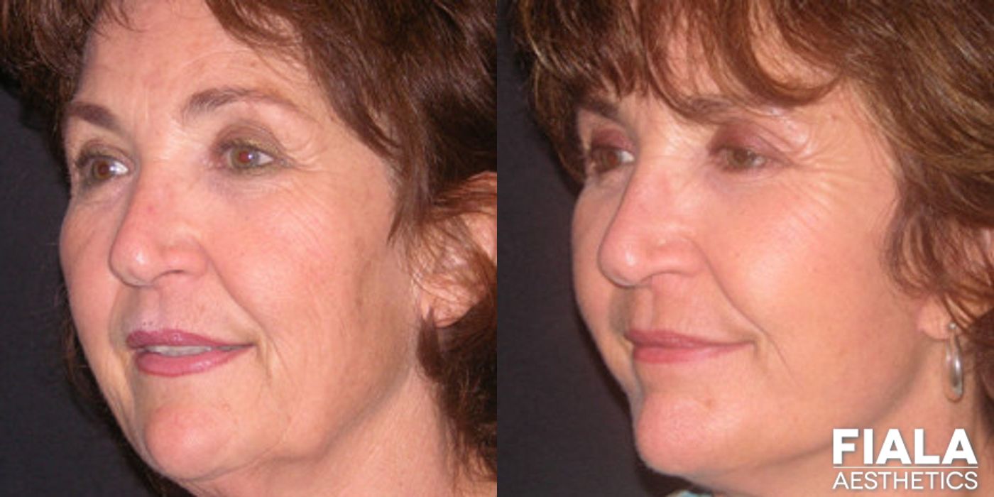 Non-surgical Facial Rejuvenation - Thumbnail 2