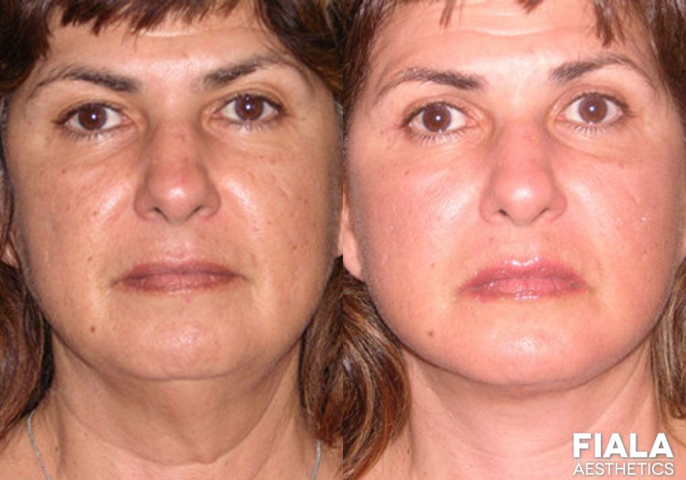Dermal Fillers - Case 9022