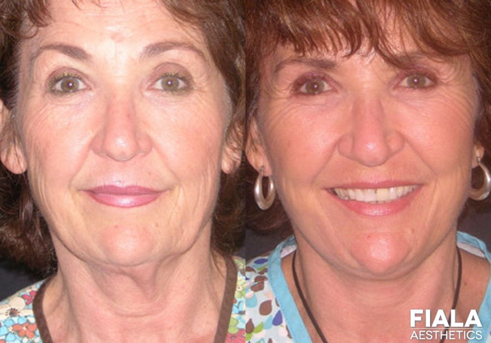 Dermal Fillers - Case 9019