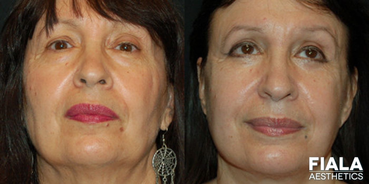 Before and after Eyelid Lift case 13887
