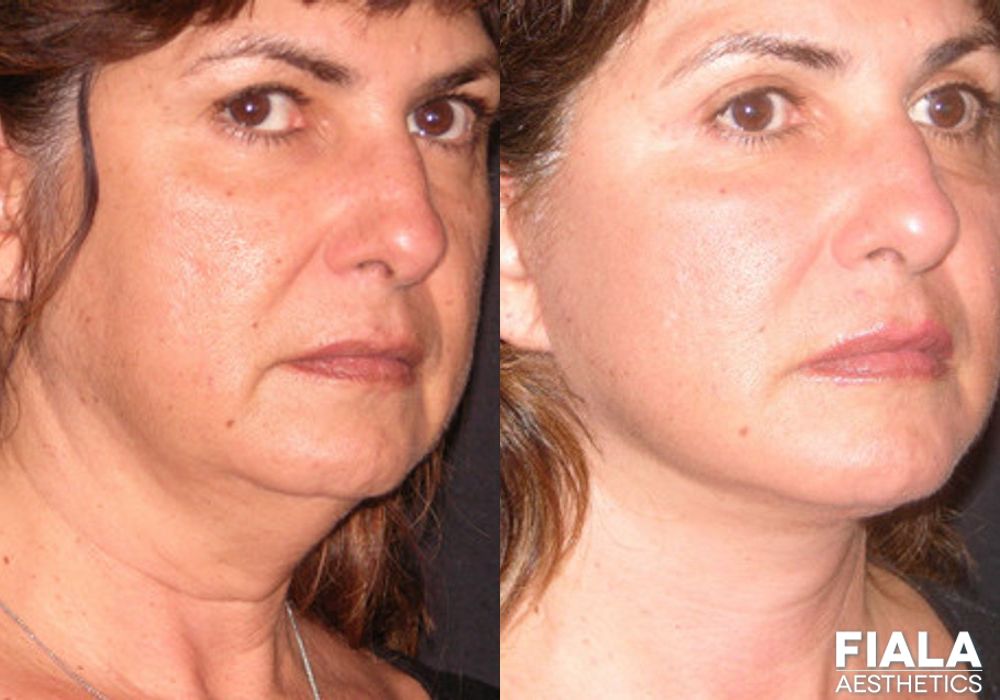 Dermal Fillers - Thumbnail 2