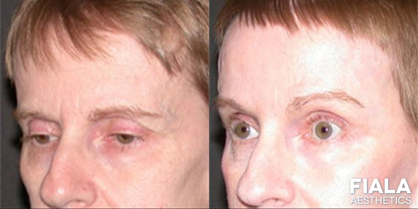 Before and after Forehead Lift case 13907 - Angle 2