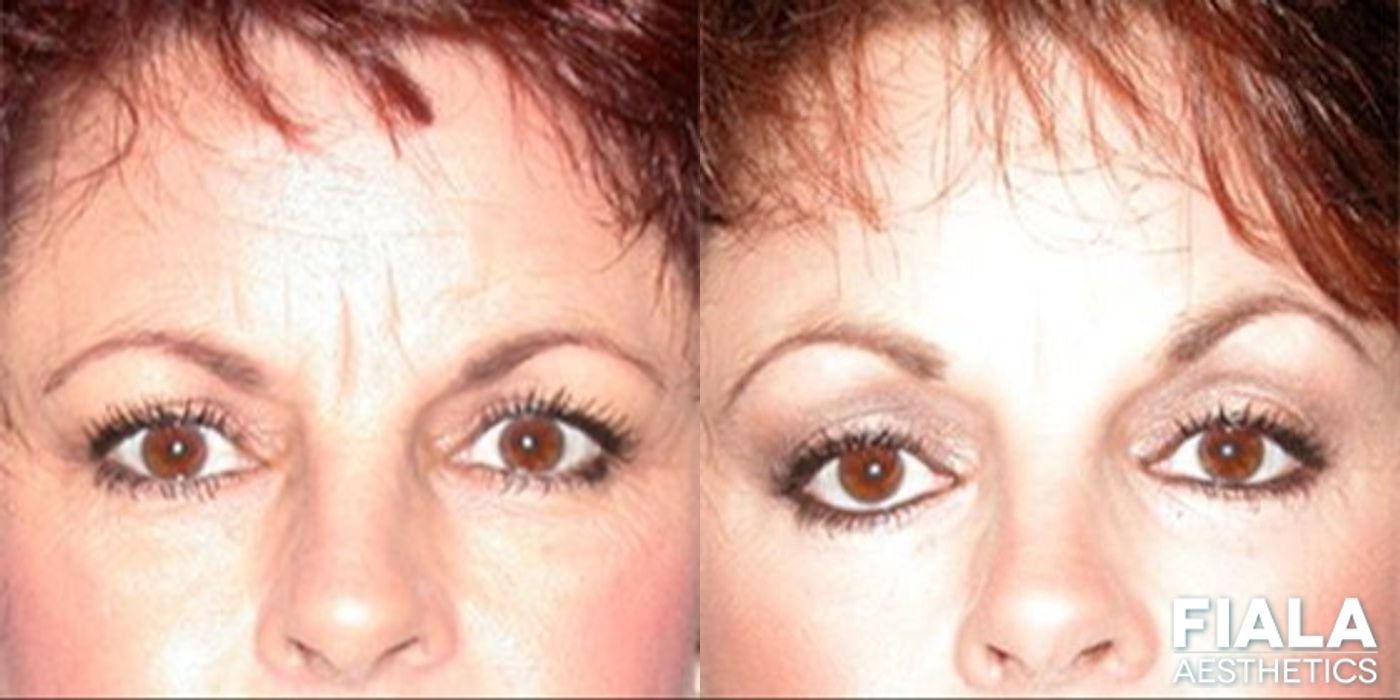 Before and after Forehead Lift case 13904