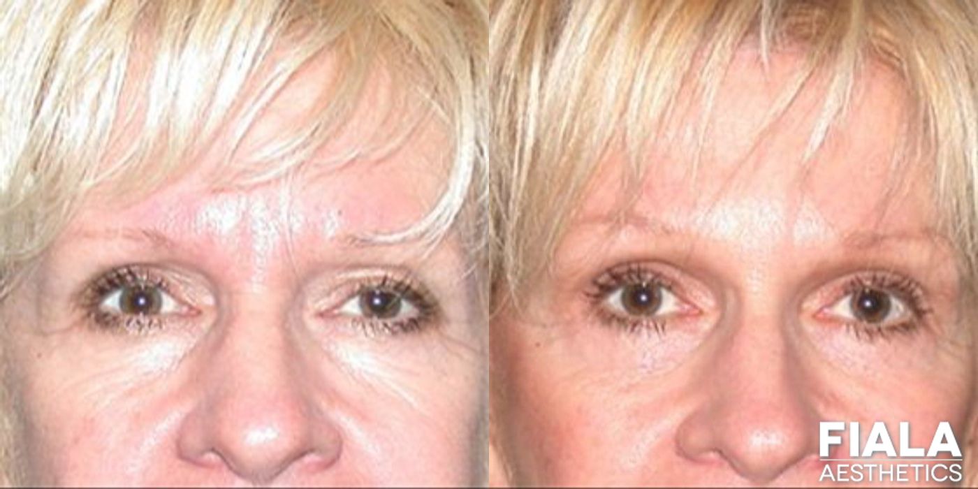 Forehead Lift - Case 9279